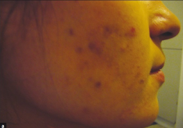 مقایسه اثرات لیزر کم‌توان قرمز و مادون‌قرمز در درمان آکنه ولگاریس: کدام مؤثرتر است