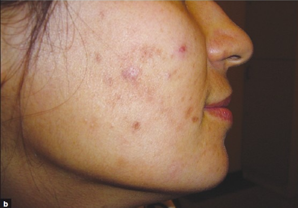 مقایسه اثرات لیزر کم‌توان قرمز و مادون‌قرمز در درمان آکنه ولگاریس: کدام مؤثرتر است