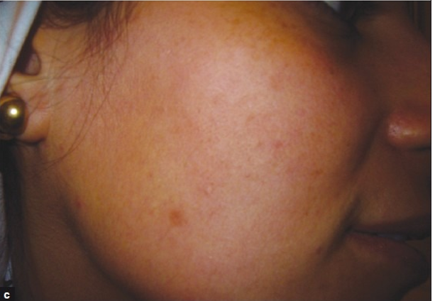 مقایسه اثرات لیزر کم‌توان قرمز و مادون‌قرمز در درمان آکنه ولگاریس: کدام مؤثرتر است