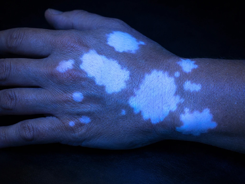 تشخیص پیشرفته بیماریهای رنگدانهای با دستگاه لامپ وود (Wood’s Lamp)