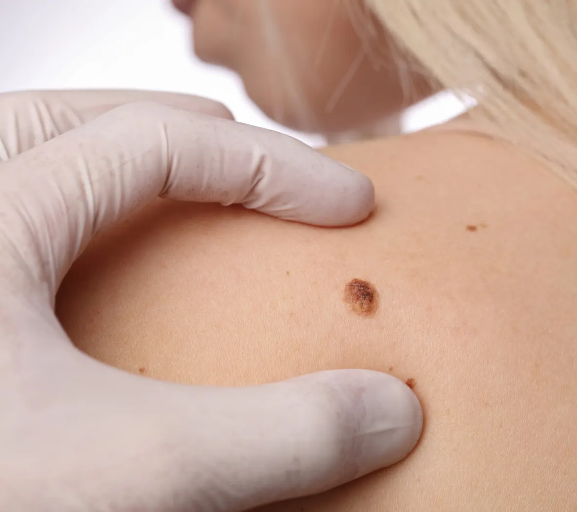 بررسی ضایعات و خال های گوشتی با دستگاه درماتوسکوپ