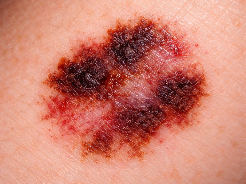 تشخیص زودهنگام سرطان پوست