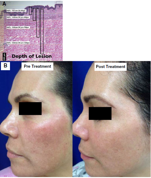 بررسی درمان ملاسما با لیزر و نوردرمانی