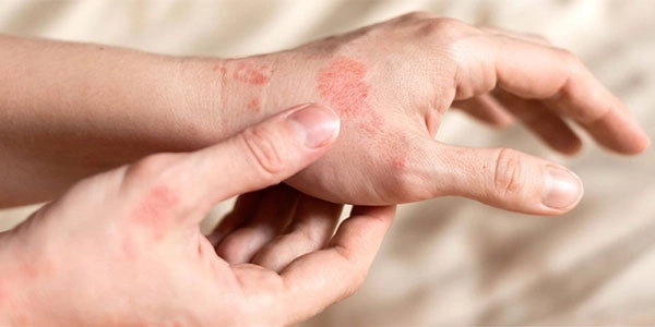 ماهیت التهاب و قرمزی پوست ماهیت التهاب و قرمزی پوست