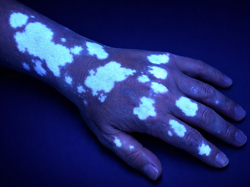 تشخیص دقیق بیماری ویتیلیگو با استفاده از دستگاه لامپ وود