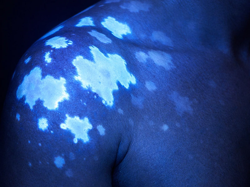 تمایز ویتیلیگو از سایر اختلالات رنگ‌دانه‌ای