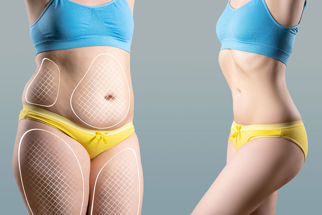 تفاوت لاغری کلی و کانتورینگ موضعی بدن