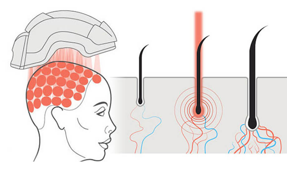 ریزش موی آندروژنتیک و محدودیت درمان‌های کلاسیک
