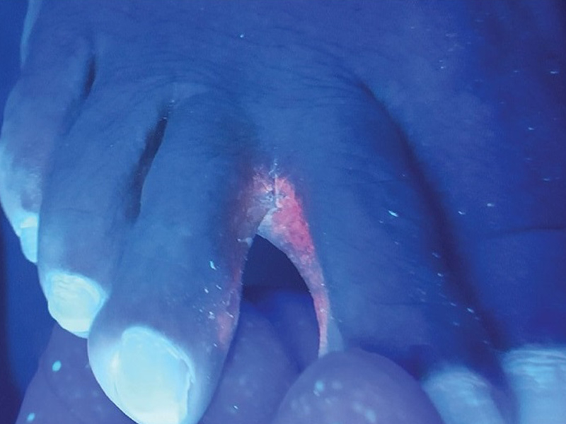 تشخیص بیماری قارچ با لامپ وود