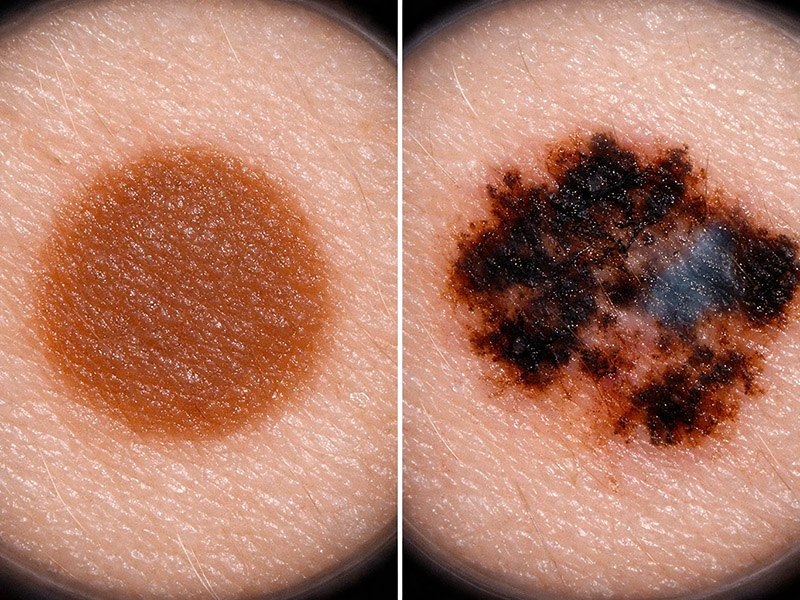 تشخیص زودهنگام سرطان پوست با دستگاه درماتوسکوپ شرکت کاویان گستر