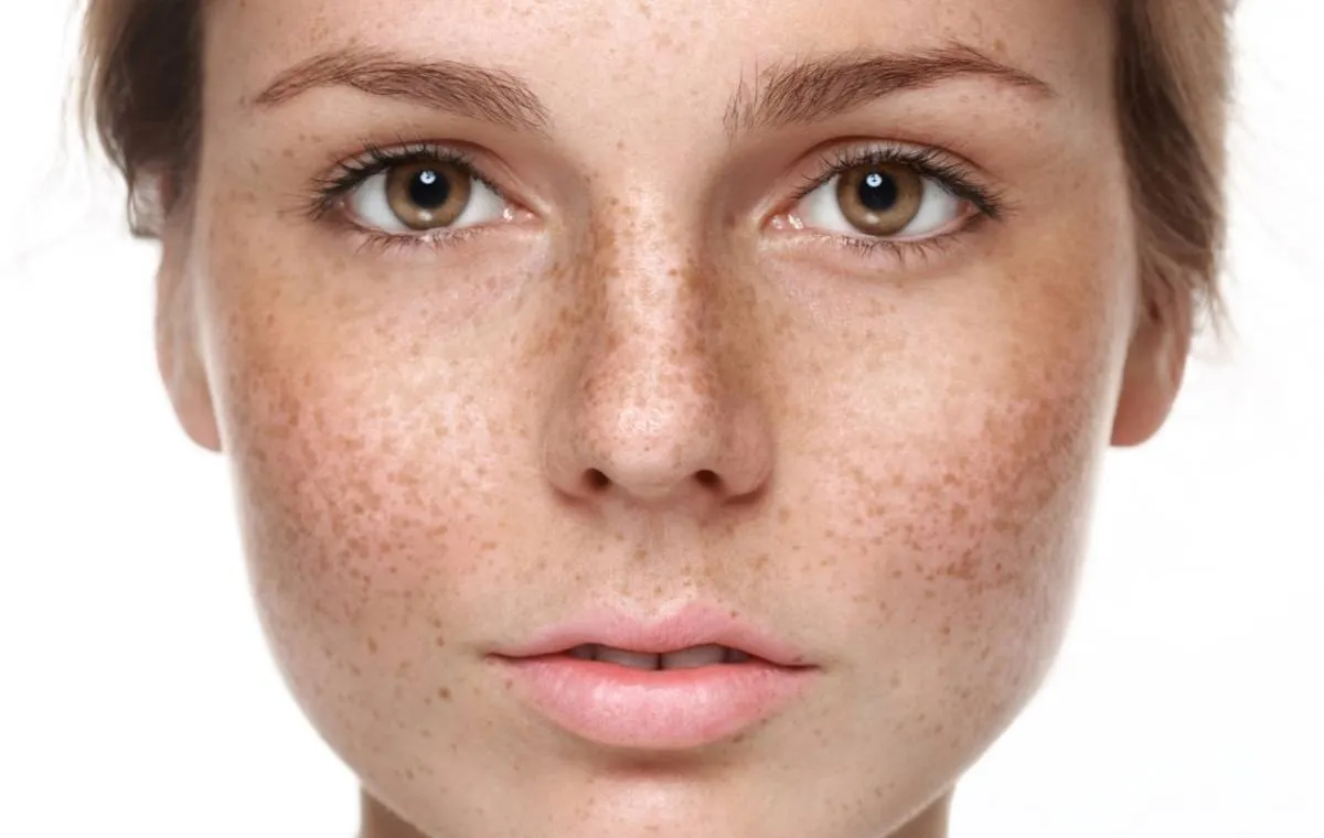 بررسی درمان ملاسما با لیزر و نوردرمانی (PDT)