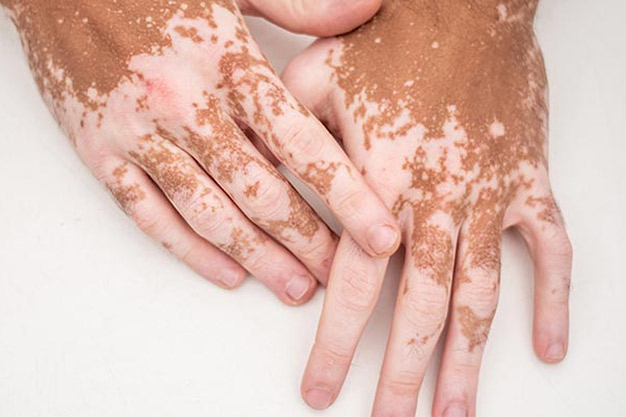 شناخت ویتیلیگو و چالشهای درمانی آن