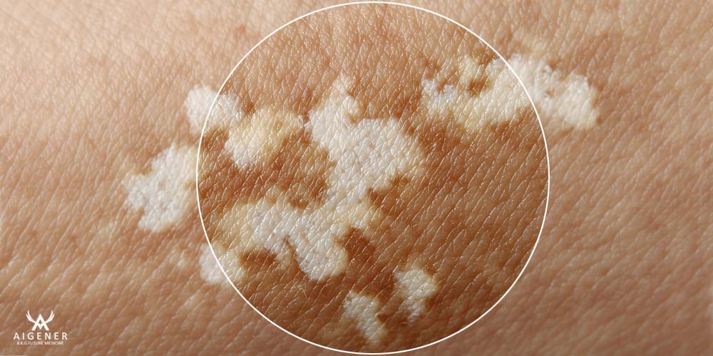 شناخت ویتیلیگو و چالش‌های درمانی آن