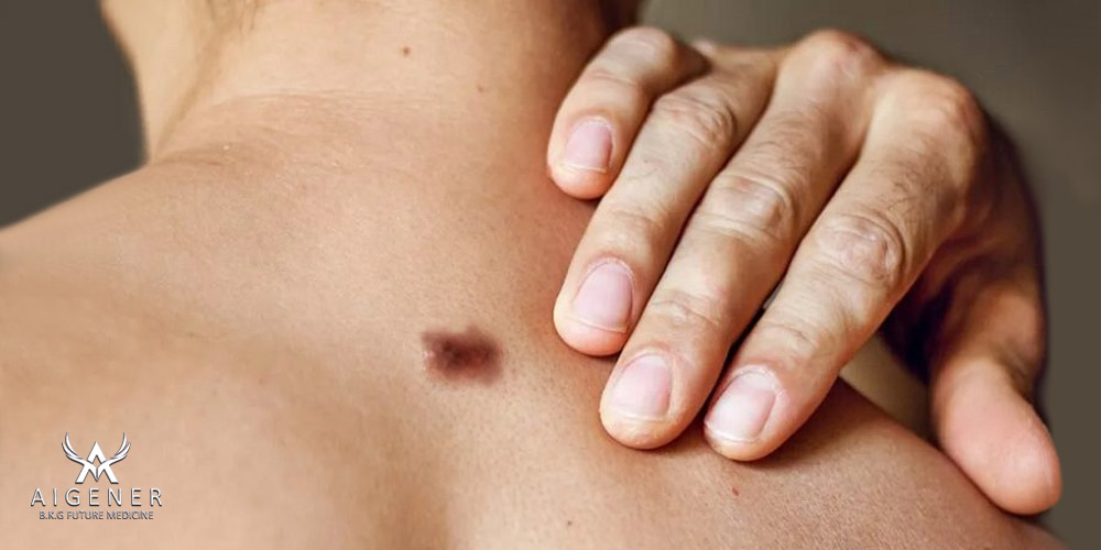 تشخیص ضایعات خوش خیم و بدخیم پوستی با دستگاه لامپ وود