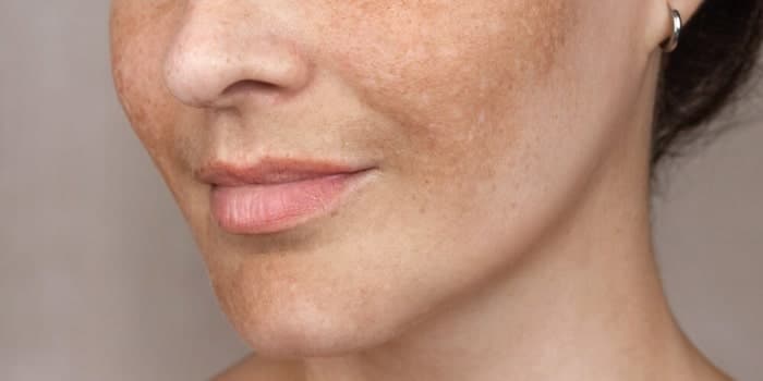 فتوبایومدولیشن با نور زرد در مقایسه با ترانکسامیک اسید برای درمان ملاسما